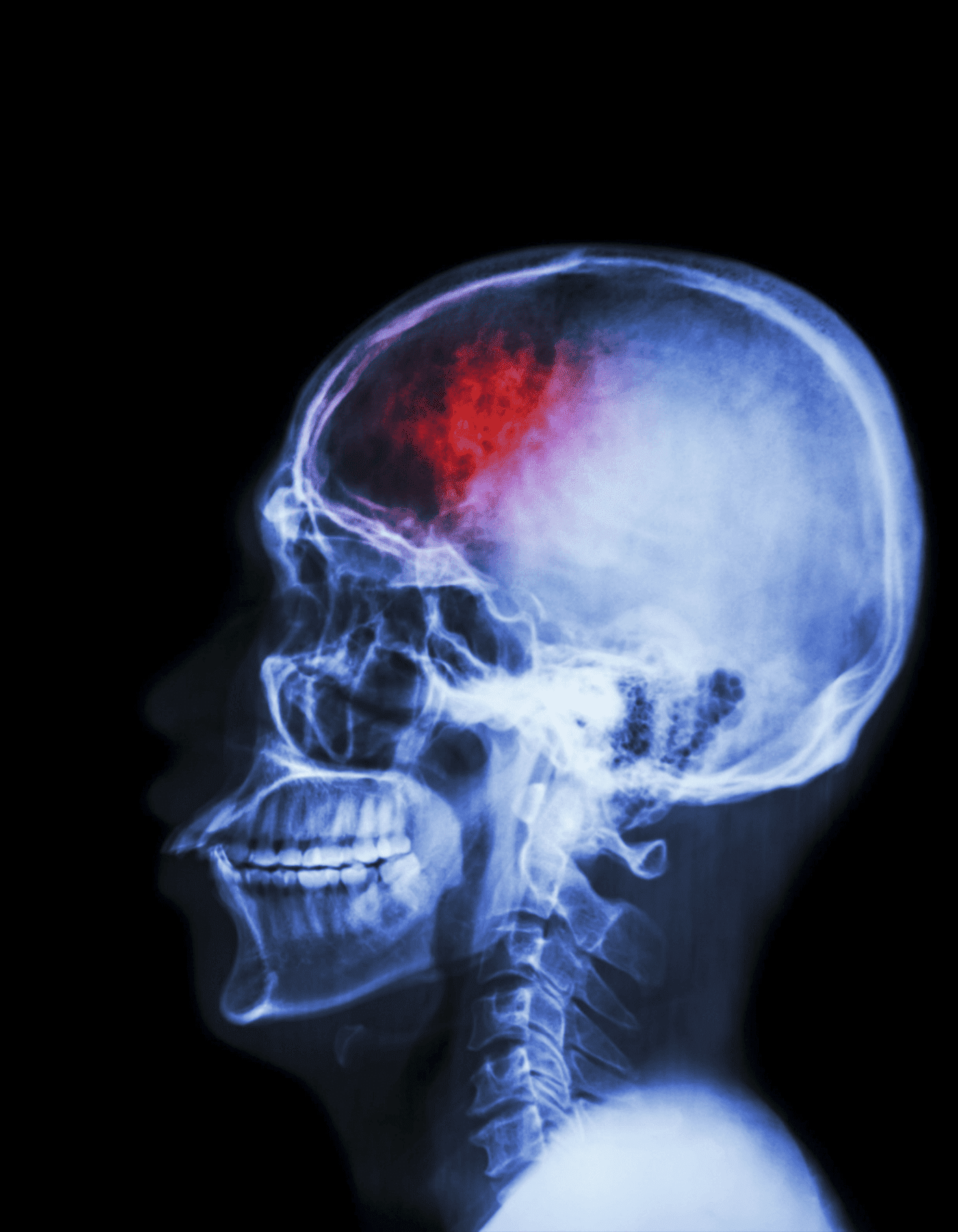 cirugias-de-trauma-de-craneo